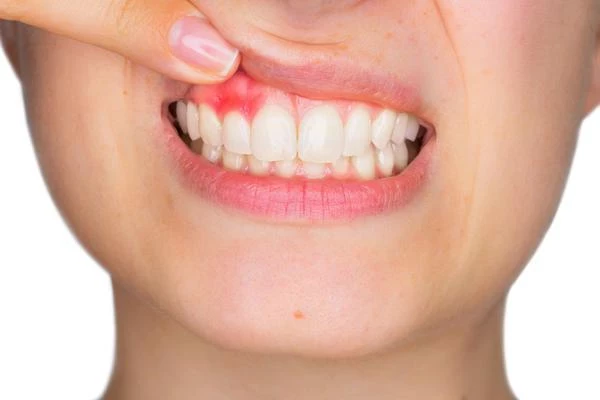 牙齦出血頻繁發生，或與這6個問題息息相關，不要忽視