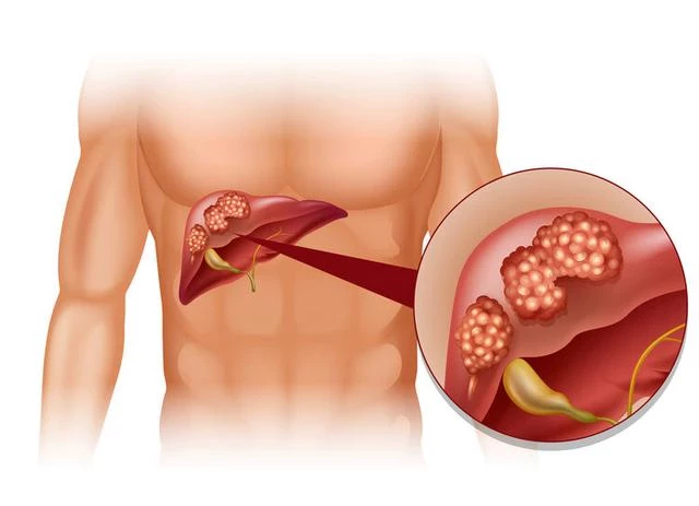 肝癌發出的第一個信號，通常出現在腹部，不少人卻當成胃病了