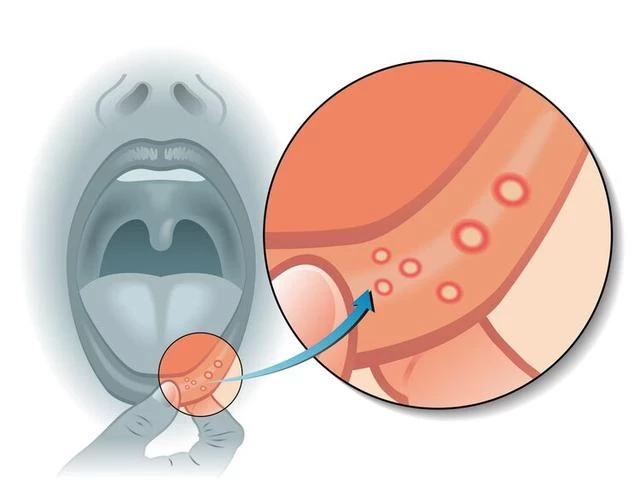 體內有癌，嘴巴先知？口腔若出現3種跡象可能是癌症來臨的警報