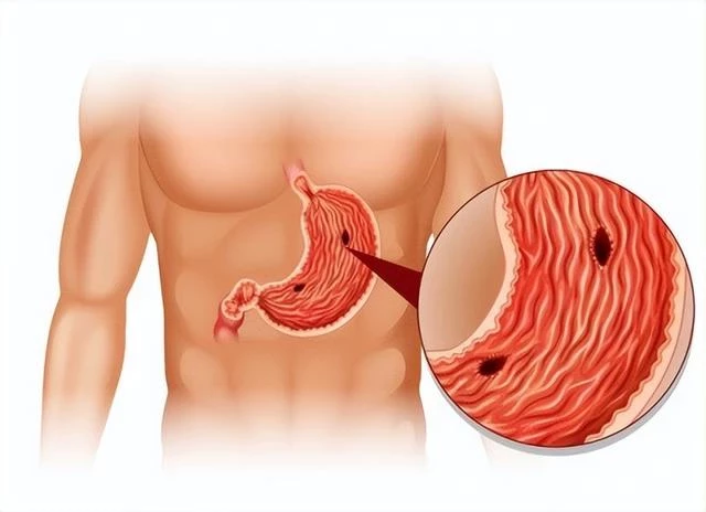 從胃炎到胃癌，只有4步！提醒：身體常出現4個症狀，需儘快就醫