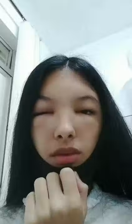 在家DIY染髮!19歲少女「隔天頭皮開始流湯」大過敏 「臉部腫到變形」對鏡子痛哭:我像個怪物