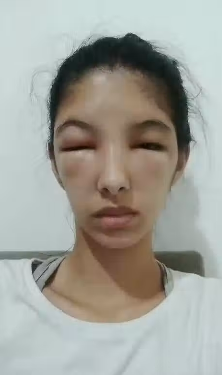 在家DIY染髮!19歲少女「隔天頭皮開始流湯」大過敏 「臉部腫到變形」對鏡子痛哭:我像個怪物